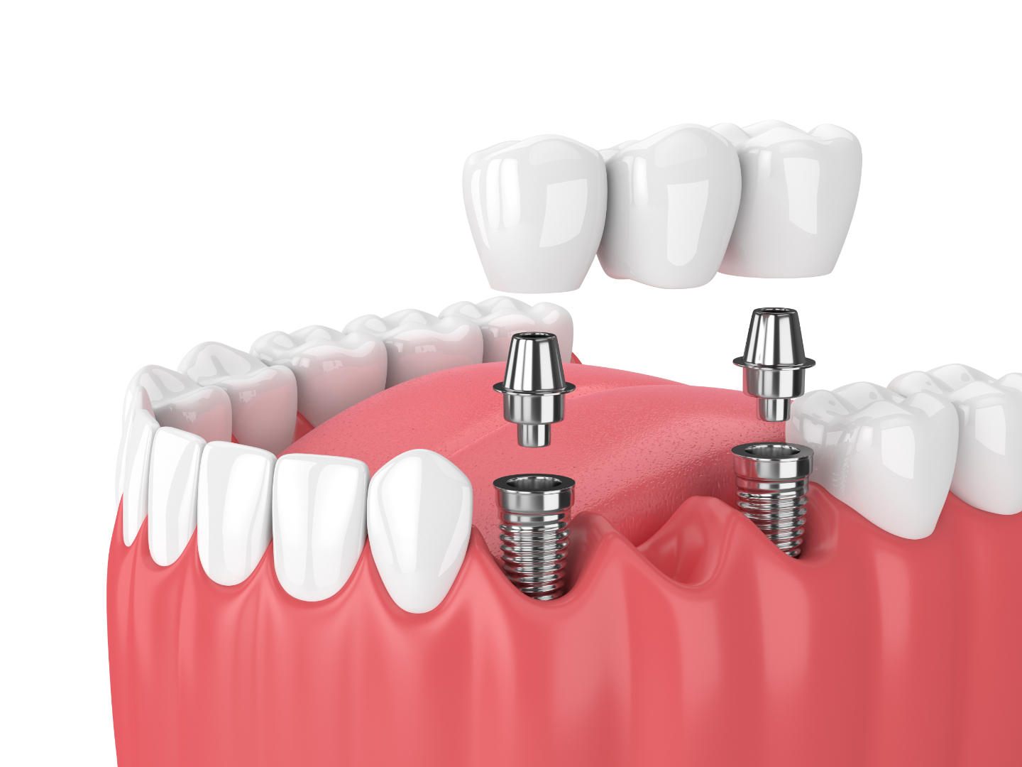 Dental Implants at Dallas Dental Care